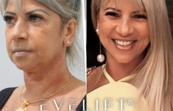 female patient before and after EVELift®