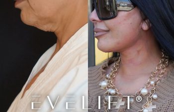 female patient before and after EVELift®