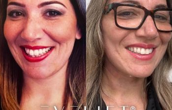 female patient before and after EVELift®