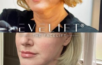 female patient before and after EVELift®