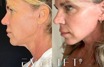 female patient before and after EVELift®