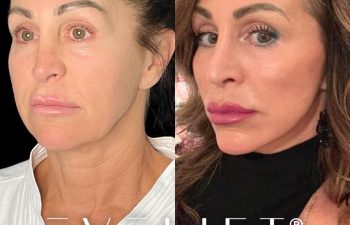 female patient before and after EVELift®