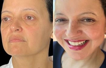 female patient before and after EVELift®