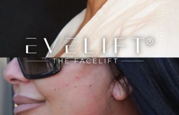 female patient before and after EVELift®