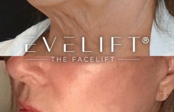 female patient before and after EVELift®