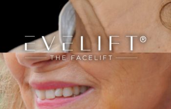 female patient before and after EVELift®