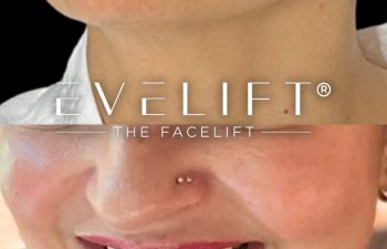 female patient before and after EVELift®
