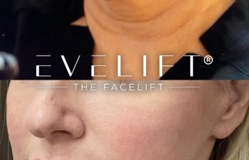 female patient before and after EVELift®