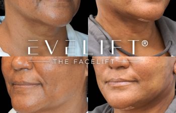 female patient before and after EVELift®