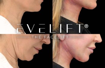 female patient before and after EVELift®