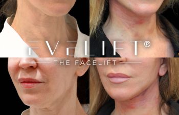 female patient before and after EVELift®