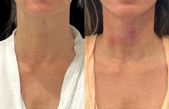 female patient before and after EVELift®
