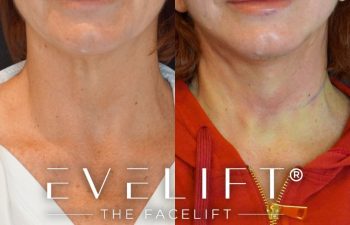female patient before and after EVELift®