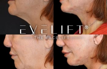 female patient before and after EVELift®