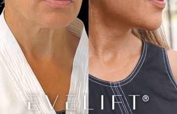 female patient before and after EVELift®