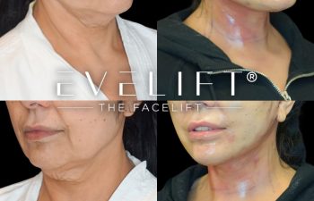 female patient before and after EVELift®