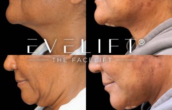 female patient before and after EVELift®