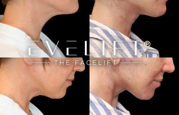 female patient before and after EVELift®