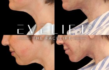 female patient before and after EVELift®