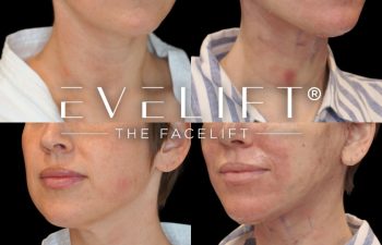 female patient before and after EVELift®