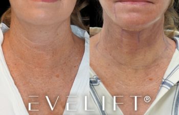 female patient before and after EVELift®