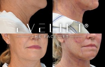 female patient before and after EVELift®