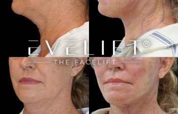 female patient before and after EVELift®
