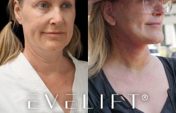 female patient before and after EVELift®