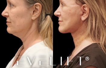 female patient before and after EVELift®
