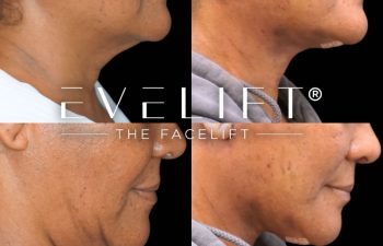 female patient before and after EVELift®