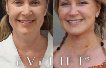 female patient before and after EVELift®