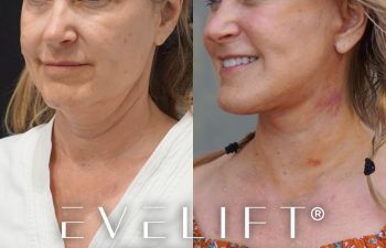female patient before and after EVELift®