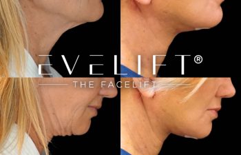 female patient before and after EVELift®
