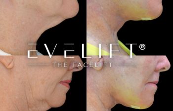 female patient before and after EVELift®