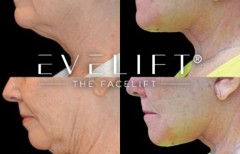 female patient before and after EVELift®