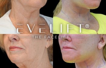 female patient before and after EVELift®