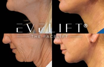 female patient before and after EVELift®