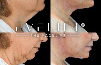 female patient before and after EVELift®