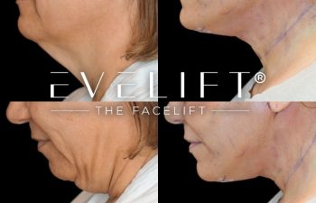 female patient before and after EVELift®