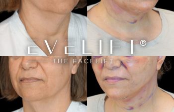 female patient before and after EVELift®