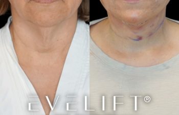 female patient before and after EVELift®