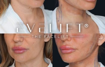 female patient before and after EVELift®