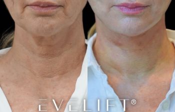 female patient before and after EVELift®