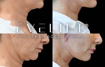 female patient before and after EVELift®