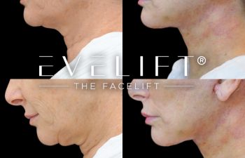 female patient before and after EVELift®