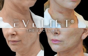 female patient before and after EVELift®