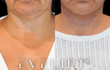 female patient before and after EVELift®