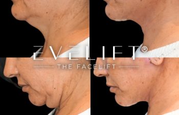 female patient before and after EVELift®