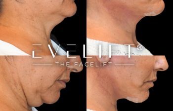 female patient before and after EVELift®