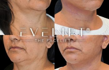 female patient before and after EVELift®